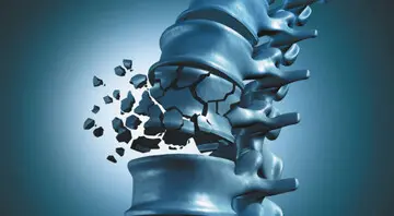 چگونه از شر پوکی استخوان راحت شویم؟
