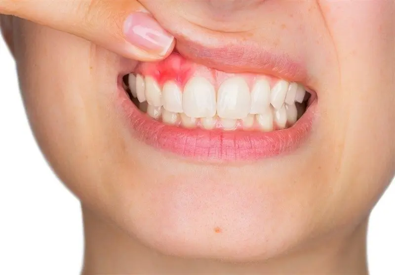 برای جلوگیری از خونریزی لثه چه کار کنیم؟