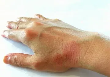 ۵ ترفند ساده تغذیه‌ای برای بهبود زخم روی پوست

