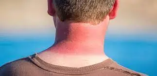 چگونه آفتاب سوختگی را درمان کنیم؟