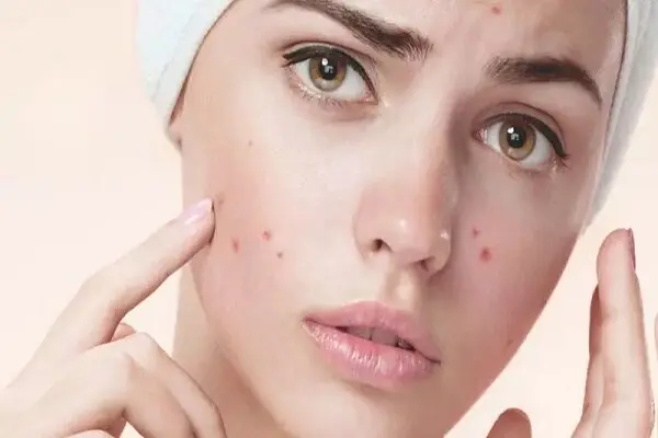چند روش طبیعی برای از بین بردن جوش‌های صورت