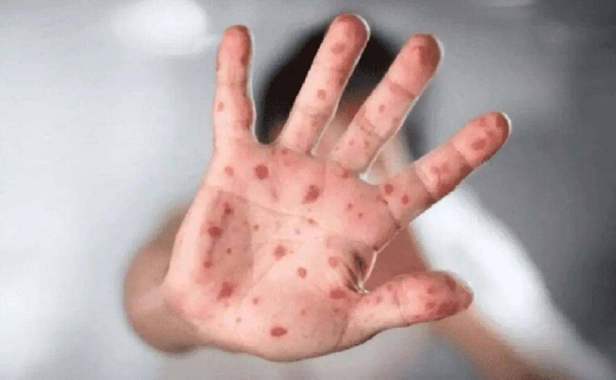شیوع آبله میمونی چقدر خطرناک است؟