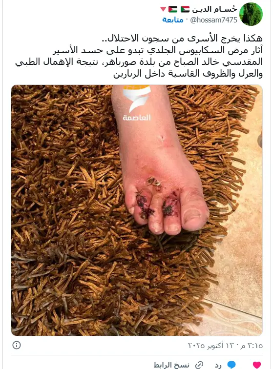 اسرای فلسطینی با یک بیماری مسری بازگشتند