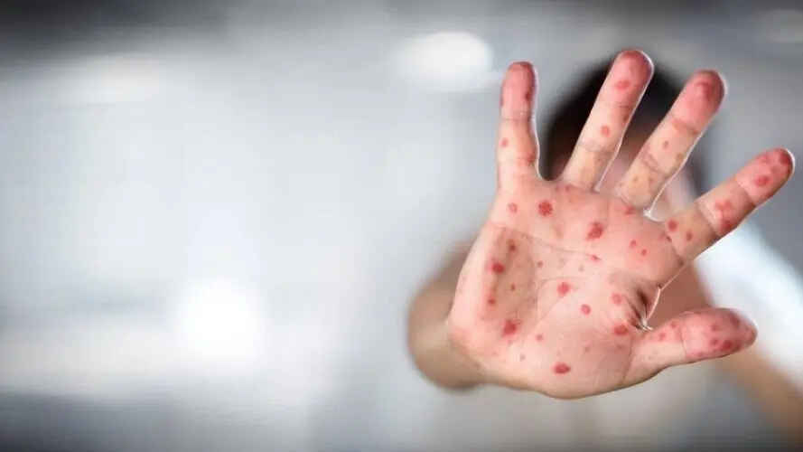 از کجا بفهمیم آبله میمونی گرفتیم یا آبله مرغان؟
