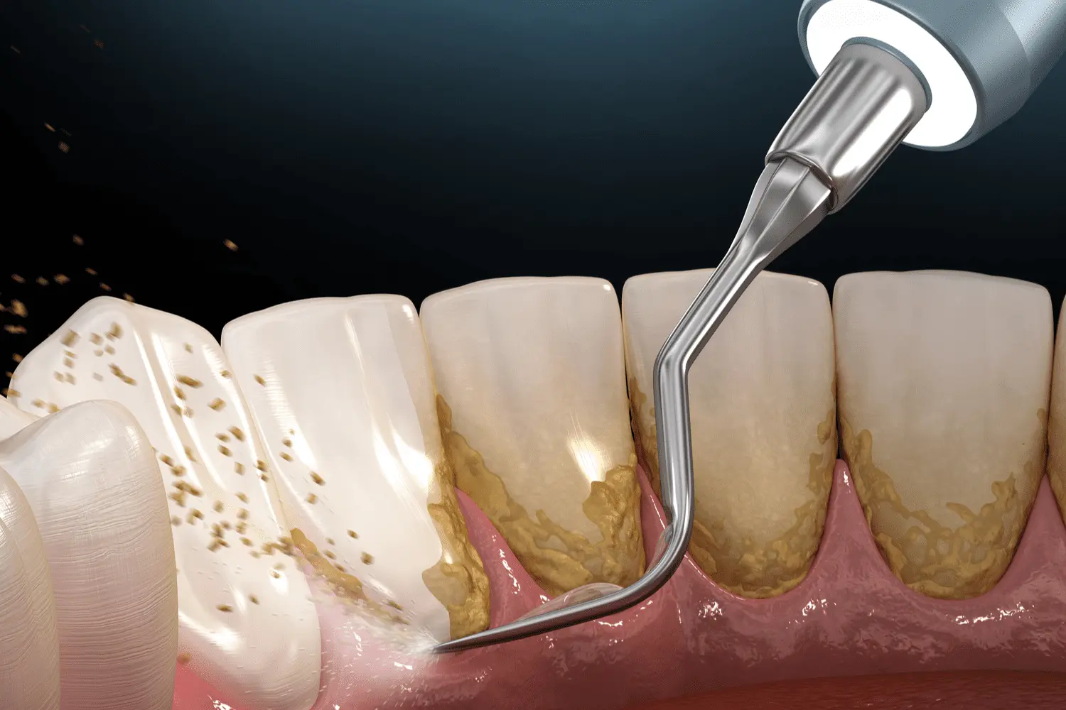 تاثیرات جرم گرفتن دندان‌ها بر سلامت؛ جرم‌گیری بکنیم یا نه؟