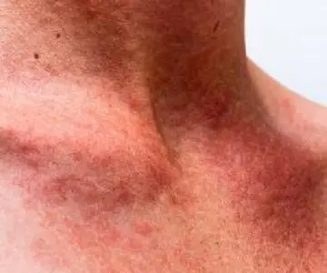 ۵ روش ساده برای تسکین فوری عرق‌ سوزی