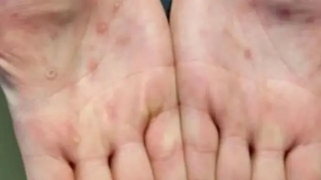 دیگر خبری از این ویروس در جهان نیست