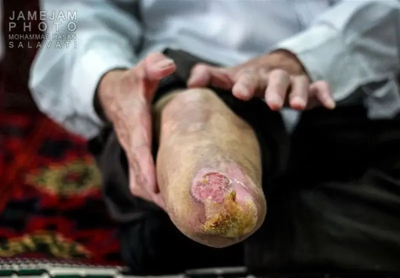 با ساکنان شهرک جذامی‌ها آشنا شوید/ در اینجا همه جذامی‌ هستند+جزییات (۱۶+)