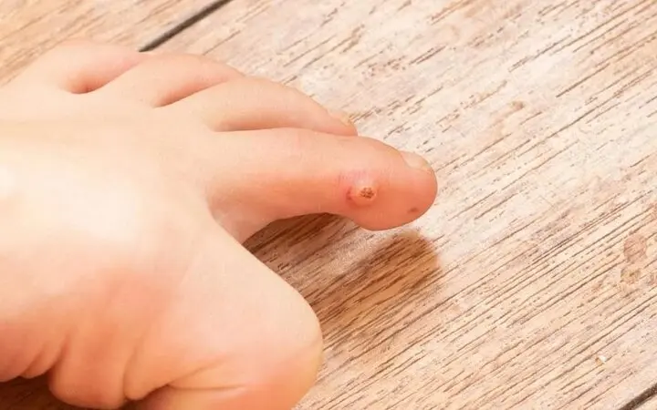 میخچه چگونه درمان می‌شود؟