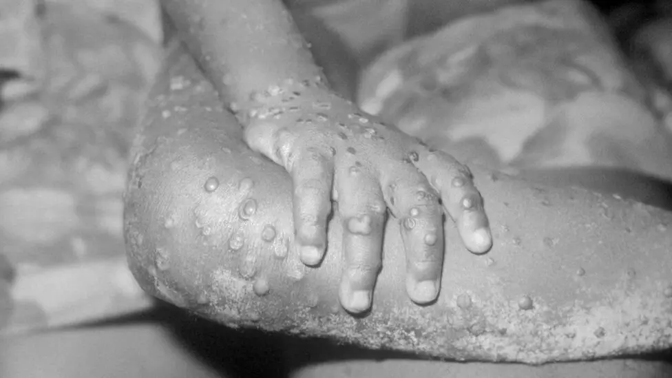 آماده باش واحدهای بهداشتی ایران برای آبله میمون
