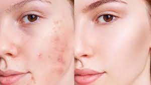 آیا استفاده از خمیردندان برای از بین بردن جوش صورت موثر است؟