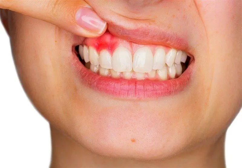 برای جلوگیری از خونریزی لثه چه کار کنیم؟