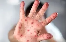 بیماری سرخک از کدام کشور وارد ایران شد؟