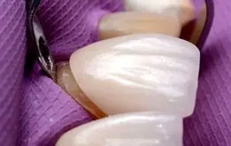 آیا لمینت دندان دائمی است؟

