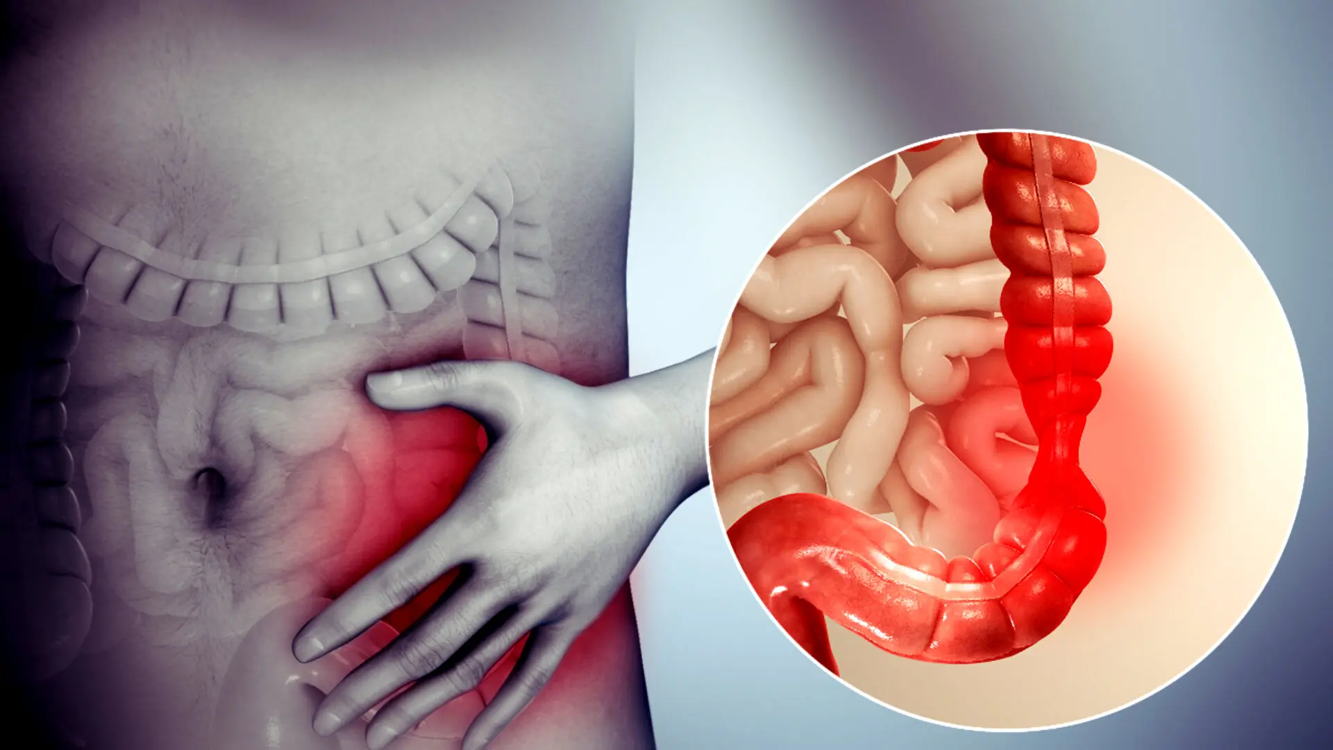 چه چیزی باعث التهاب روده می شود؟