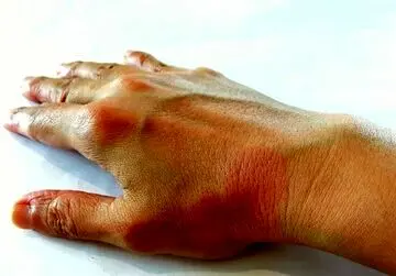 ۵ ترفند ساده تغذیه‌ای برای بهبود زخم روی پوست

