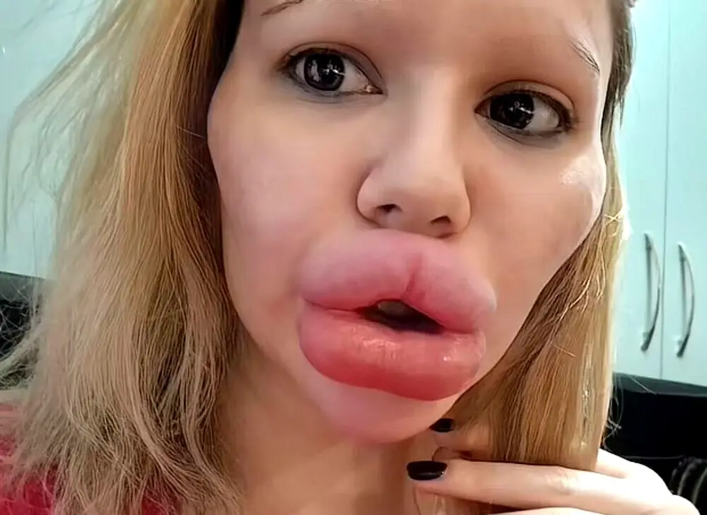 چهره وحشتناک زنی که مدام به لب هایش ژل می زند