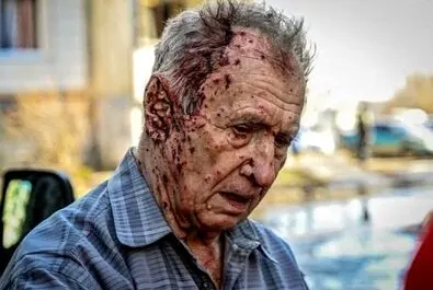  یکی از مجروحان حملات روسیه به اوکراین