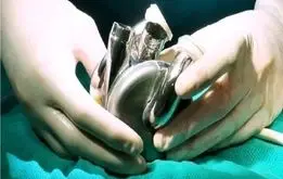 رکوردشکنی مرد استرالیایی با قلب مصنوعی