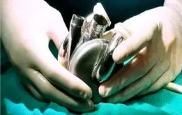 رکوردشکنی مرد استرالیایی با قلب مصنوعی