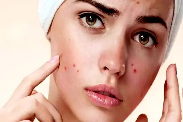 چند روش طبیعی برای از بین بردن جوش‌های صورت