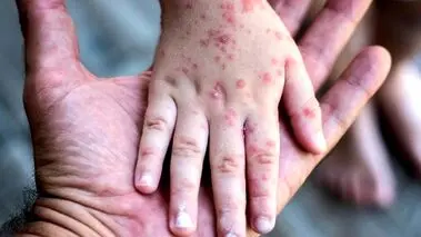 این علائم سرخک در کودکان را جدی بگیرید