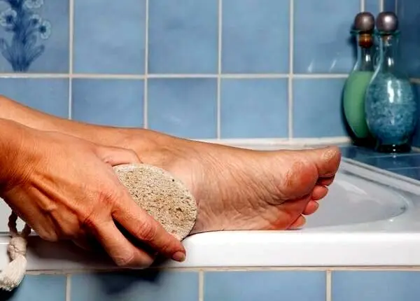 میخچه پا چیست؟ | راه درمان میخچه در منزل