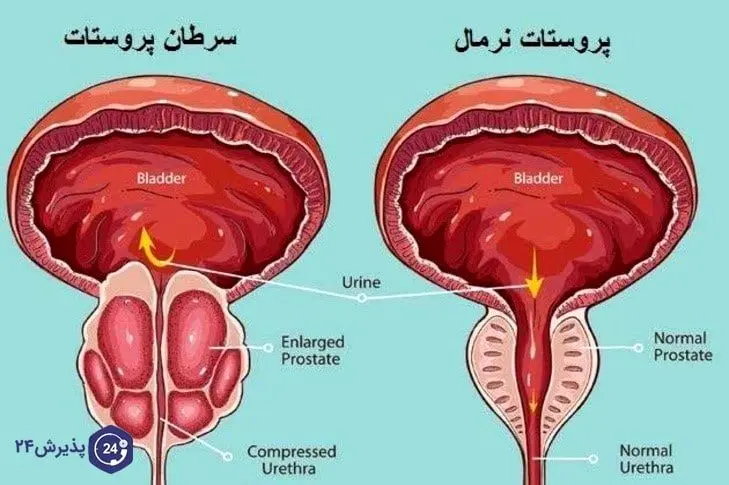 علائم سرطان پروستات بدخیم چیست؟