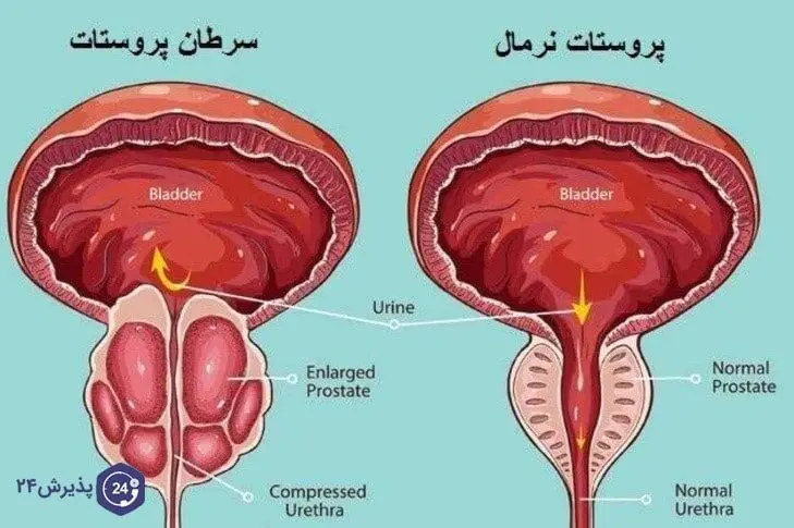 علائم سرطان پروستات بدخیم چیست؟