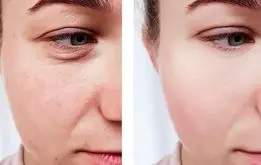 تاثیر خوردن کلاژن بر پوست چیست؟