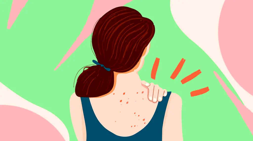 علل بروز جوش کمر/ روش‌های جلوگیری و درمان آن
