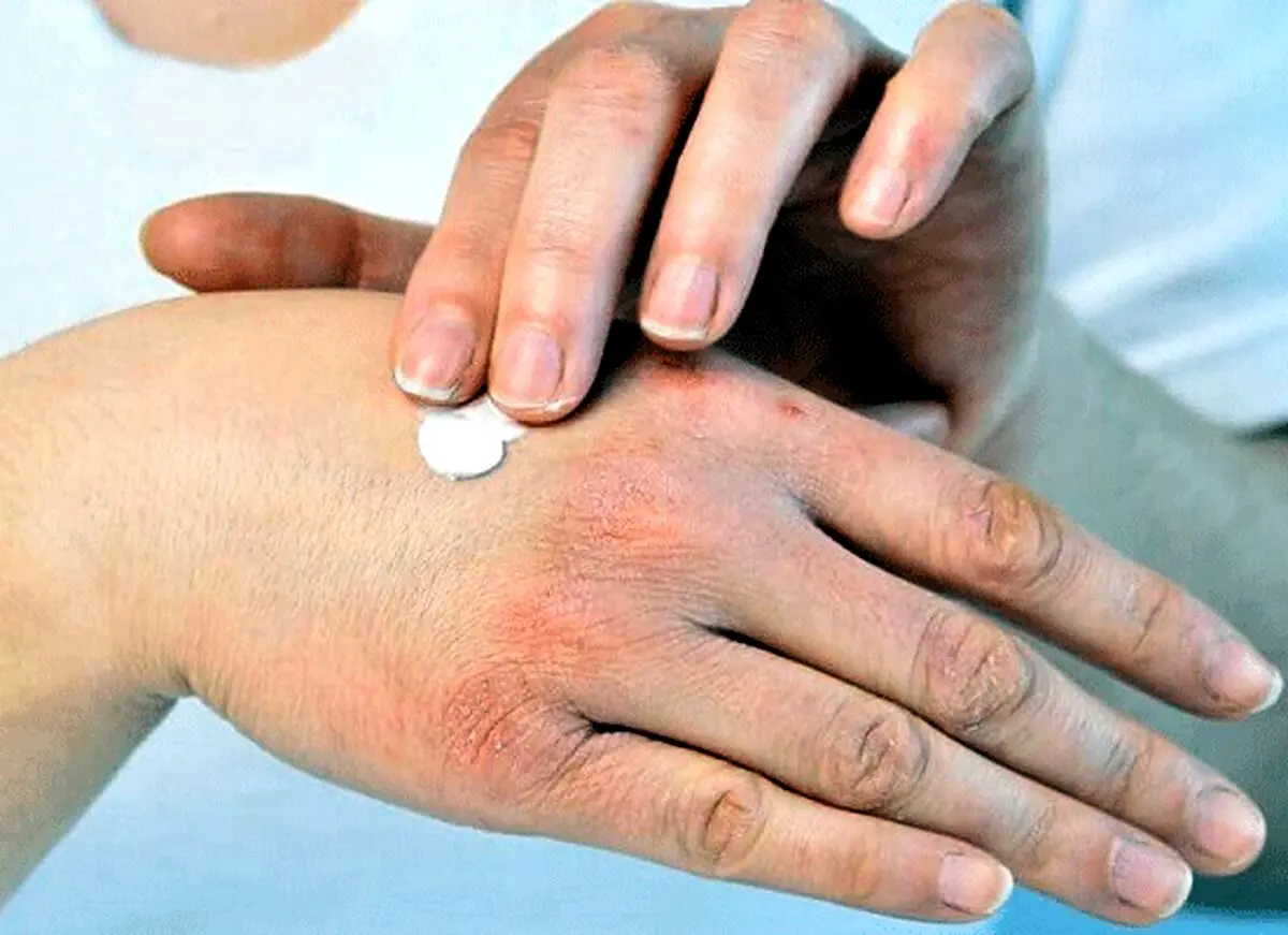 خشکی پوست در فصل سرما را چگونه از بین ببریم؟