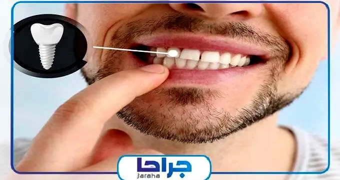 آیا ایمپلنت دندان نیاز به مراقبت ویژه دارد؟【سال1402】