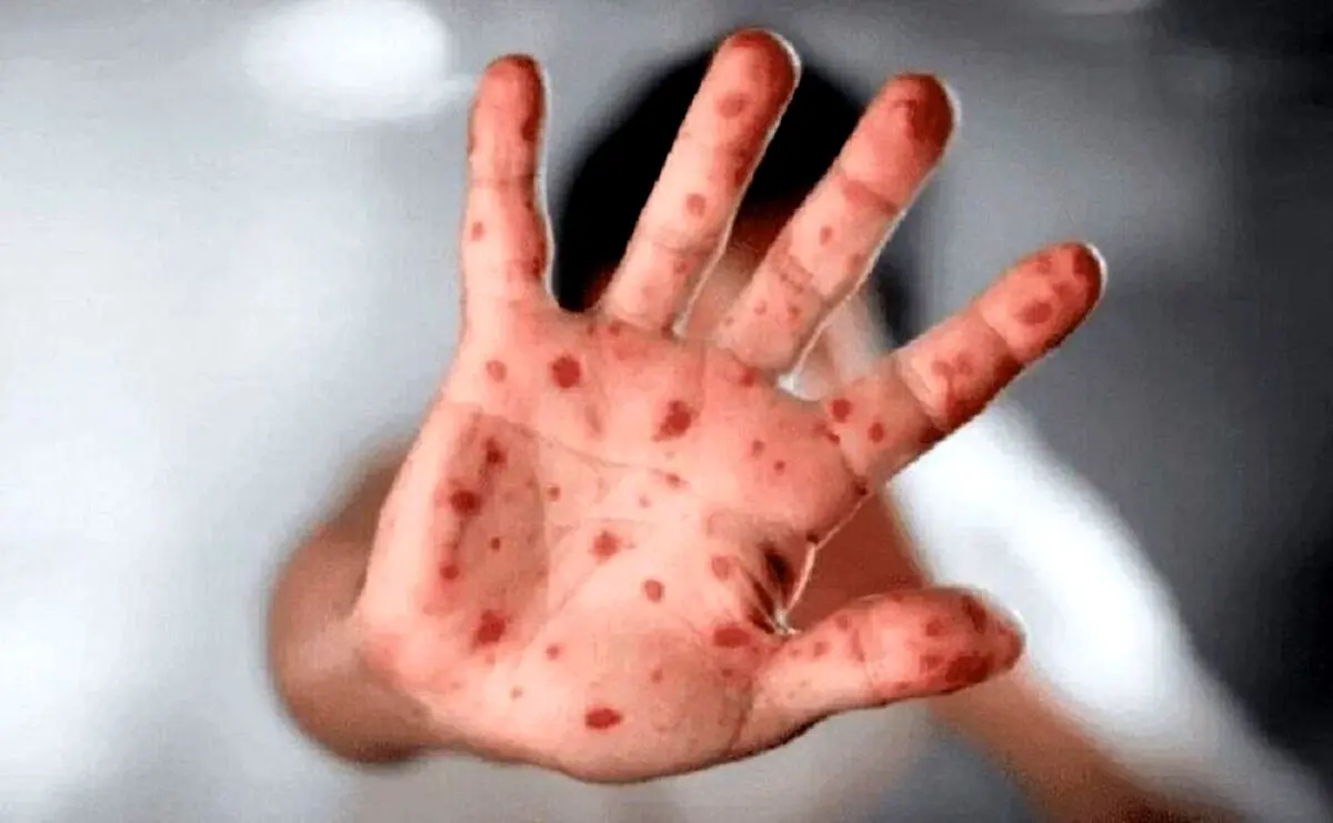 شیوع آبله میمونی چقدر خطرناک است؟
