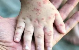 سرخک چرا بر سر زبان‌ها افتاده؟