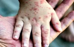 سرخک چرا بر سر زبان‌ها افتاده؟