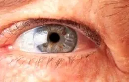 ماکولا چشمی چیست ؟ + فیلم