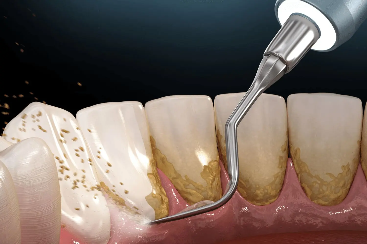 تاثیرات جرم گرفتن دندان‌ها بر سلامت؛ جرم‌گیری بکنیم یا نه؟