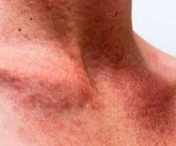 ۵ روش ساده برای تسکین فوری عرق‌ سوزی