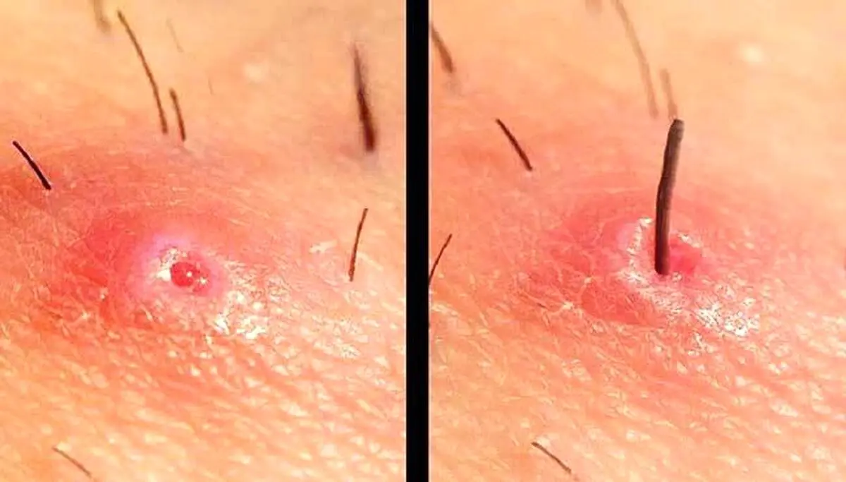 راهنمای درمان خانگی کیست مویی را بشناسید