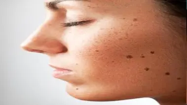 علت زیاد شدن و ایجاد خال جدید در بدن چیست؟