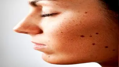 علت زیاد شدن و ایجاد خال جدید در بدن چیست؟