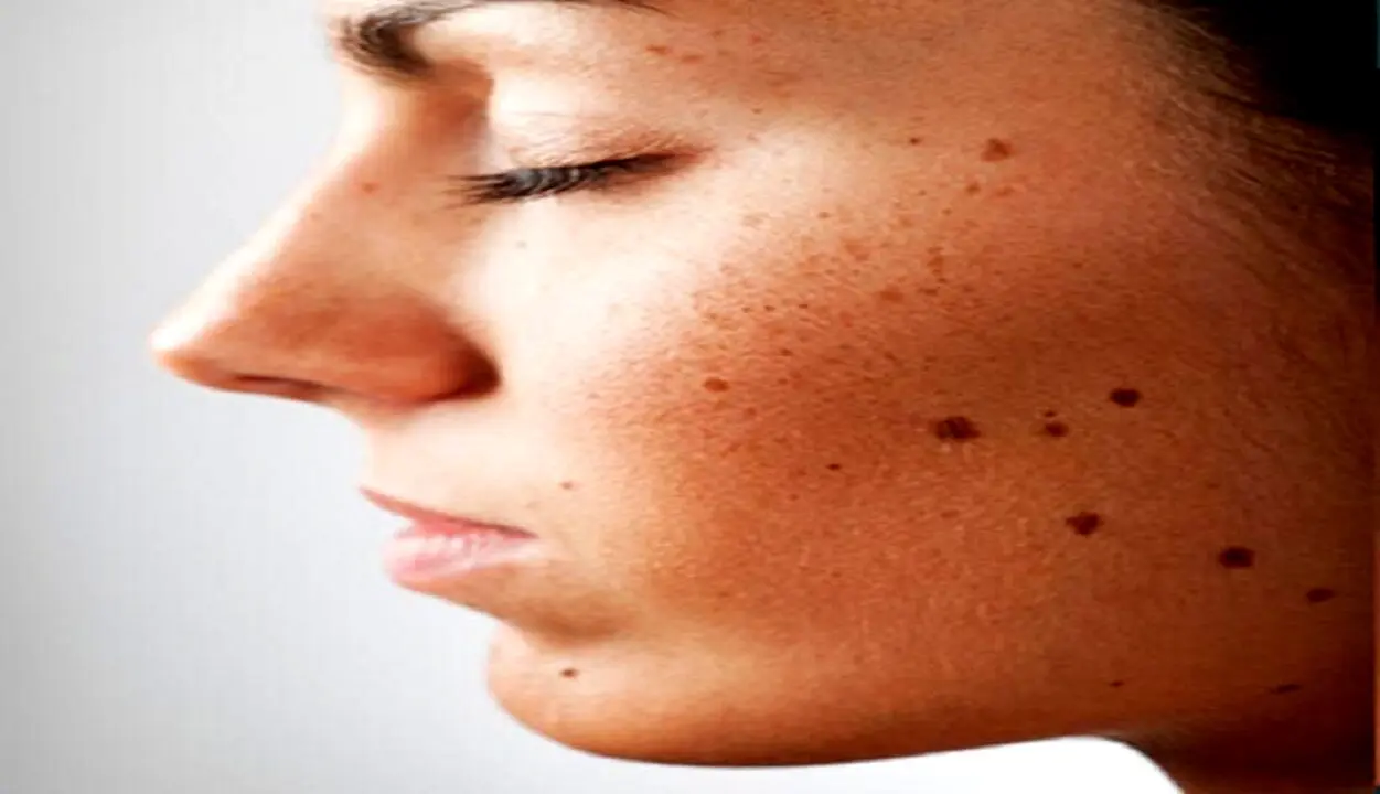 علت زیاد شدن و ایجاد خال جدید در بدن چیست؟