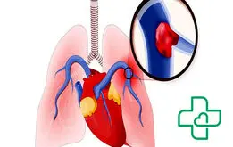 آسم ریوی و هر آنچه که باید در رابطه با آن بدانیم!

