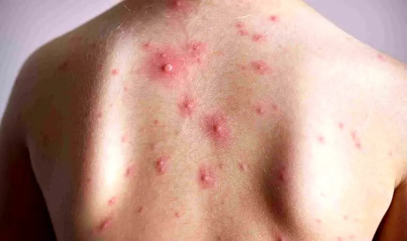 چگونه به ویروس آبله مرغان مبتلا می‌شویم؟