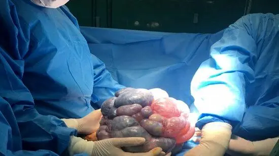 خارج کردن تومور ۷ کیلویی از دهان یک کودک ۱۱ساله