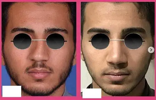 هشدار جامعه پزشکان/قیافه های تکراری با جراحی پلاستیک در ایران