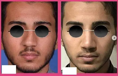 هشدار جامعه پزشکان/قیافه های تکراری با جراحی پلاستیک در ایران