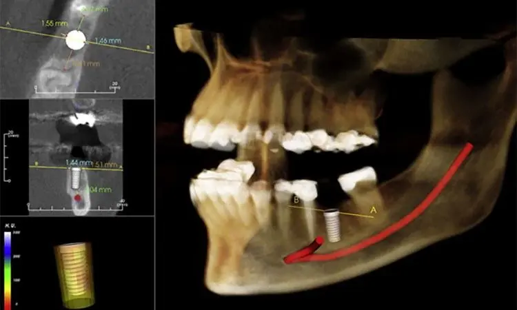 آیا عکس cbct برای کاشت ایمپلنت دندان ضروری است؟