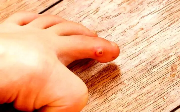 میخچه چگونه درمان می‌شود؟